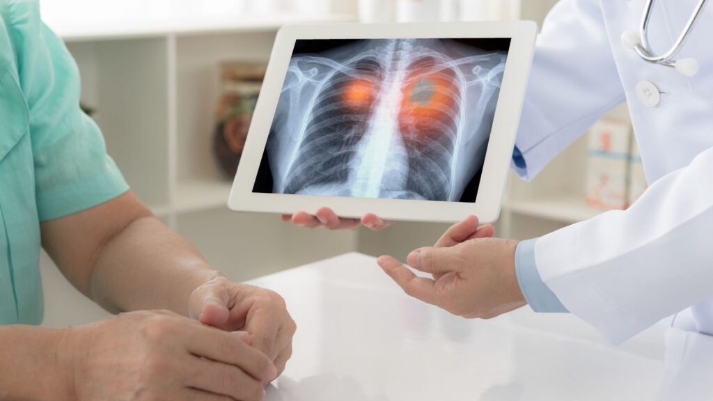 Cómo la IA Está Transformando el Diagnóstico del Cáncer de Pulmón